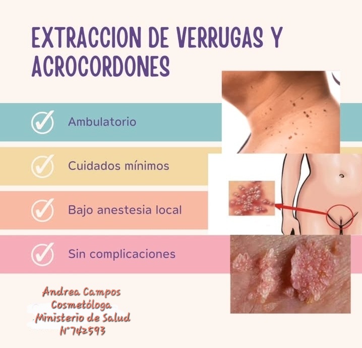 Extracción de acrocordones